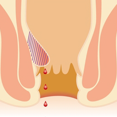 いぼ痔の初期の段階の図