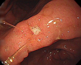 内視鏡検査で発見された胃潰瘍の写真