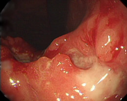 内視鏡検査で発見された胃ガンの写真