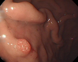 内視鏡検査で発見された胃ポリープの写真