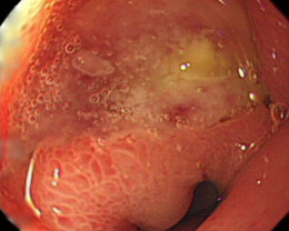 内視鏡検査で発見された十二指腸潰瘍の写真