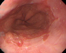 内視鏡検査で発見された逆流性食道炎の写真