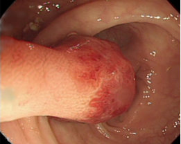内視鏡検査で発見された大腸ポリープの写真