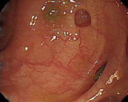 内視鏡検査で発見された大腸憩室症の写真